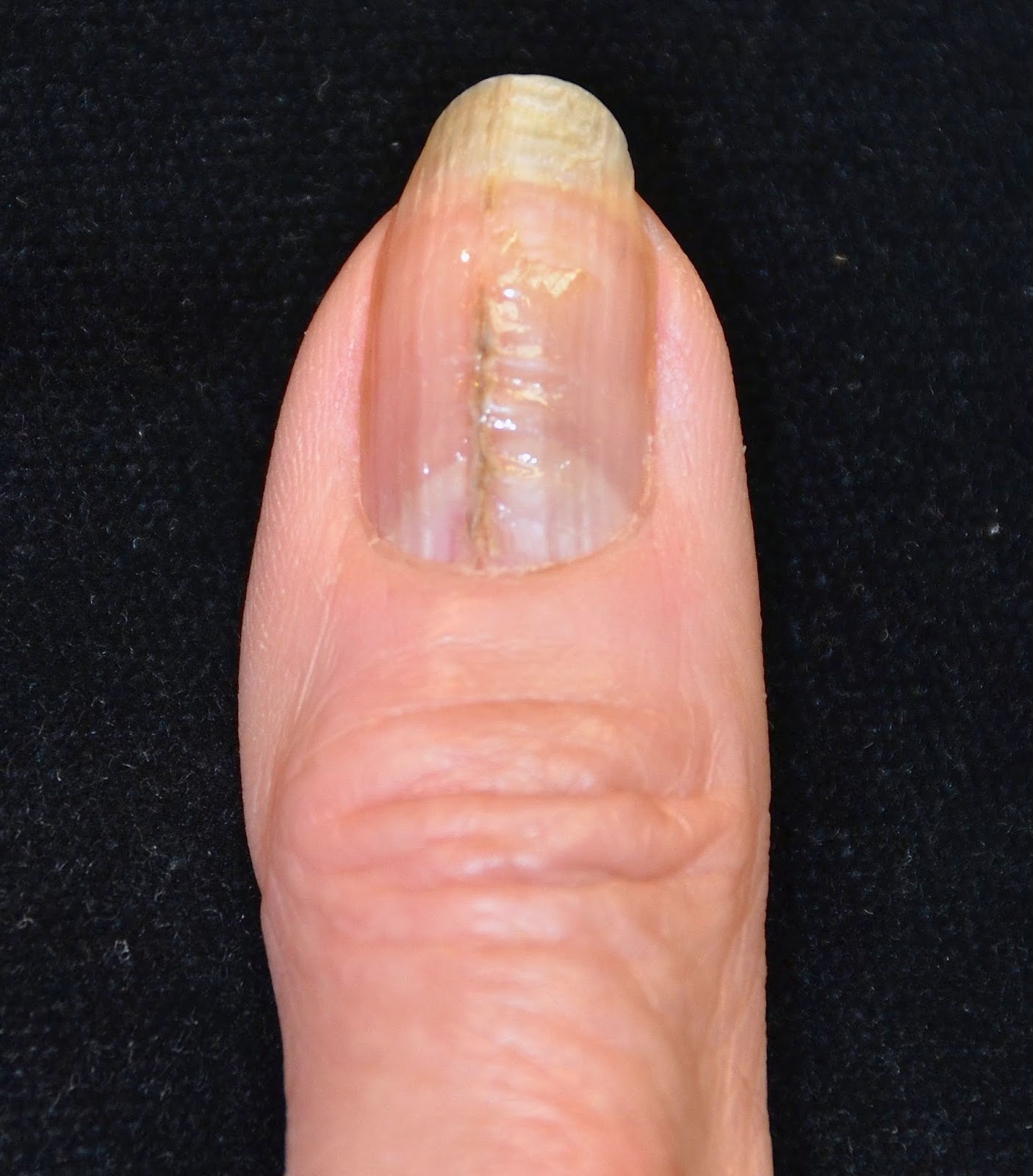 thumb nail split Thumb nail split